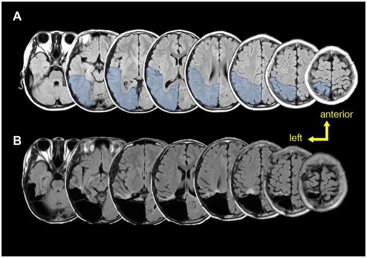 https://cdn.ncbi.nlm.nih.gov/pmc/blobs/9650/6090027/01736ac403a4/fneur-09-00644-g0004.jpg