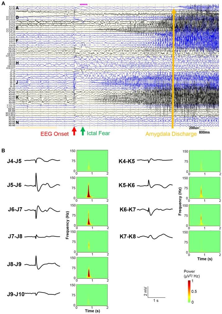 https://cdn.ncbi.nlm.nih.gov/pmc/blobs/9650/6090027/7a7903ca5508/fneur-09-00644-g0003.jpg