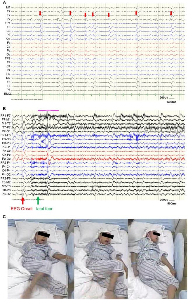 https://cdn.ncbi.nlm.nih.gov/pmc/blobs/9650/6090027/7db51bf424f2/fneur-09-00644-g0001.jpg