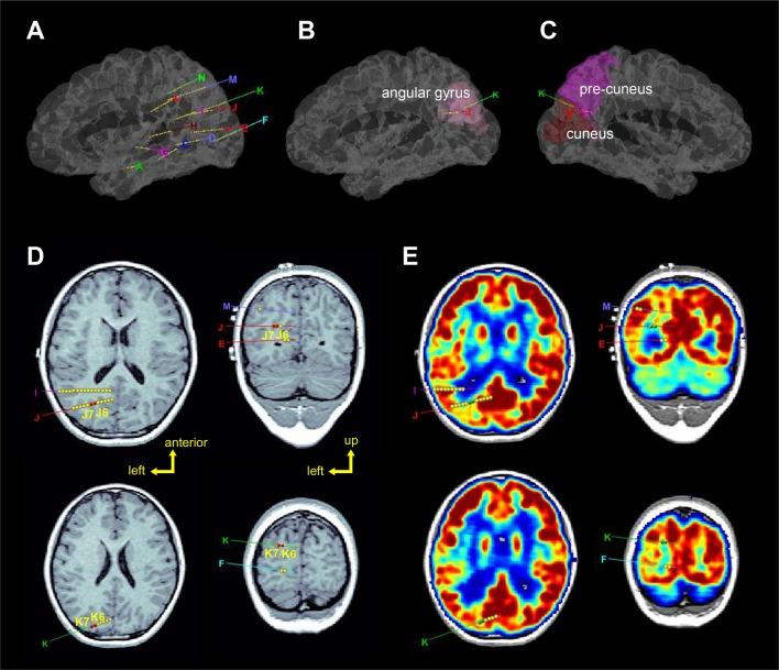 https://cdn.ncbi.nlm.nih.gov/pmc/blobs/9650/6090027/b886c576e5ba/fneur-09-00644-g0002.jpg
