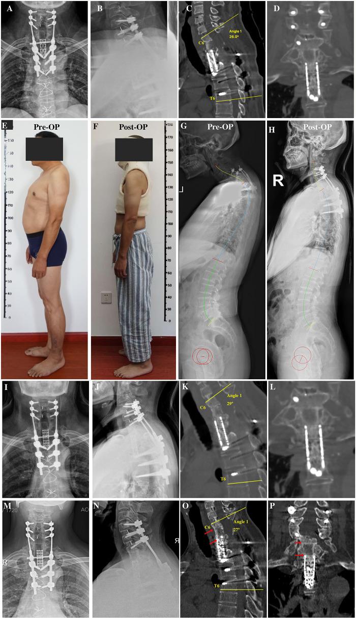 https://cdn.ncbi.nlm.nih.gov/pmc/blobs/96a4/11524943/db3dc2d61f1e/fsurg-11-1394135-g003.jpg