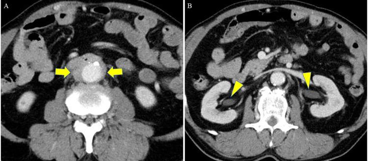 https://cdn.ncbi.nlm.nih.gov/pmc/blobs/96fc/12245851/2212dd198bdb/fsurg-12-1582823-g001.jpg