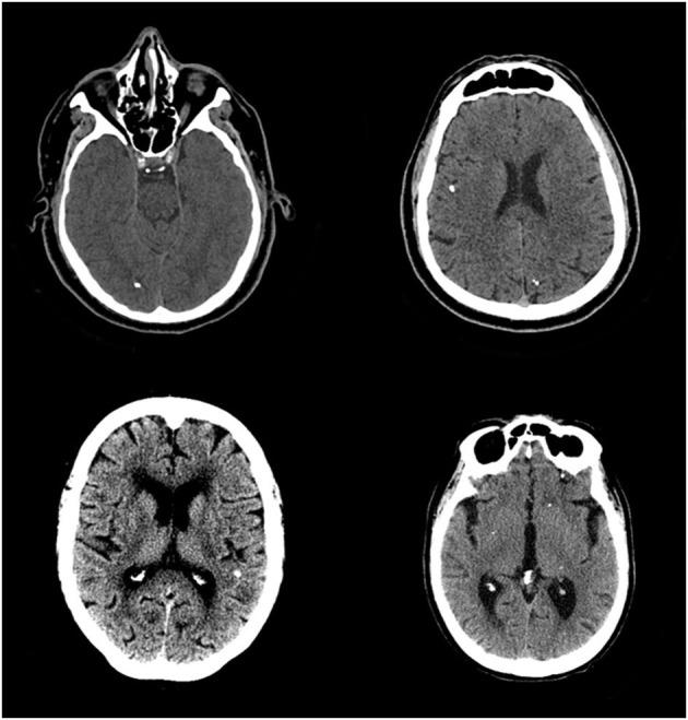 https://cdn.ncbi.nlm.nih.gov/pmc/blobs/975a/8830344/1d057f4c99aa/fneur-12-769356-g0002.jpg