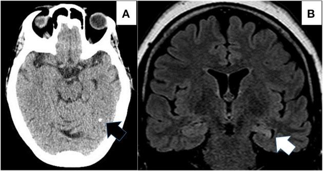 https://cdn.ncbi.nlm.nih.gov/pmc/blobs/975a/8830344/92ac56f5088e/fneur-12-769356-g0003.jpg
