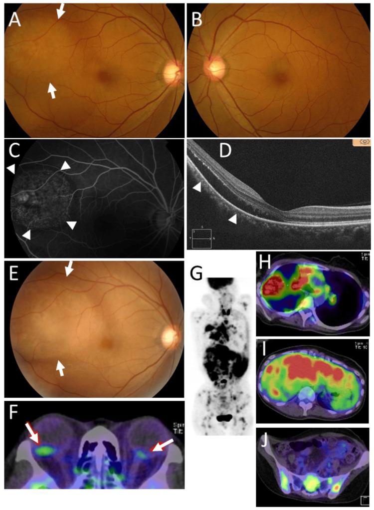 https://cdn.ncbi.nlm.nih.gov/pmc/blobs/9764/12136539/724ccb71025b/cureus-0017-00000083484-i02.jpg