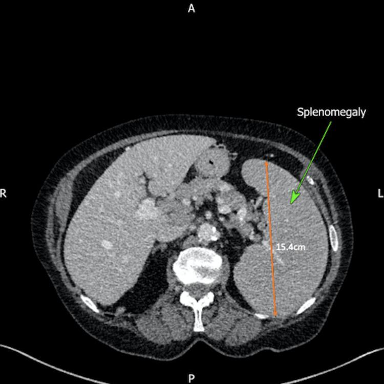 https://cdn.ncbi.nlm.nih.gov/pmc/blobs/9819/8896842/01194fd20fe0/cureus-0014-00000021823-i07.jpg