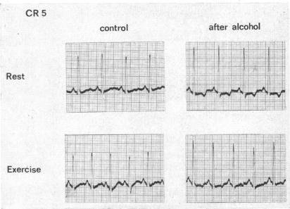 https://cdn.ncbi.nlm.nih.gov/pmc/blobs/9869/487692/c87461ec8899/brheartj00322-0057-a.jpg