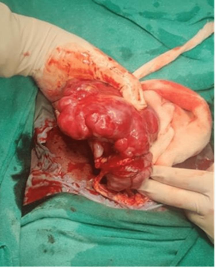 https://cdn.ncbi.nlm.nih.gov/pmc/blobs/9876/10726097/a2bb2ac49f8c/cureus-0015-00000048989-i03.jpg