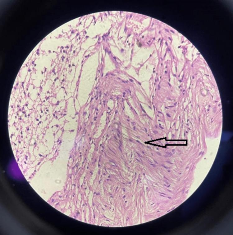 https://cdn.ncbi.nlm.nih.gov/pmc/blobs/9876/10726097/d569c306f809/cureus-0015-00000048989-i08.jpg