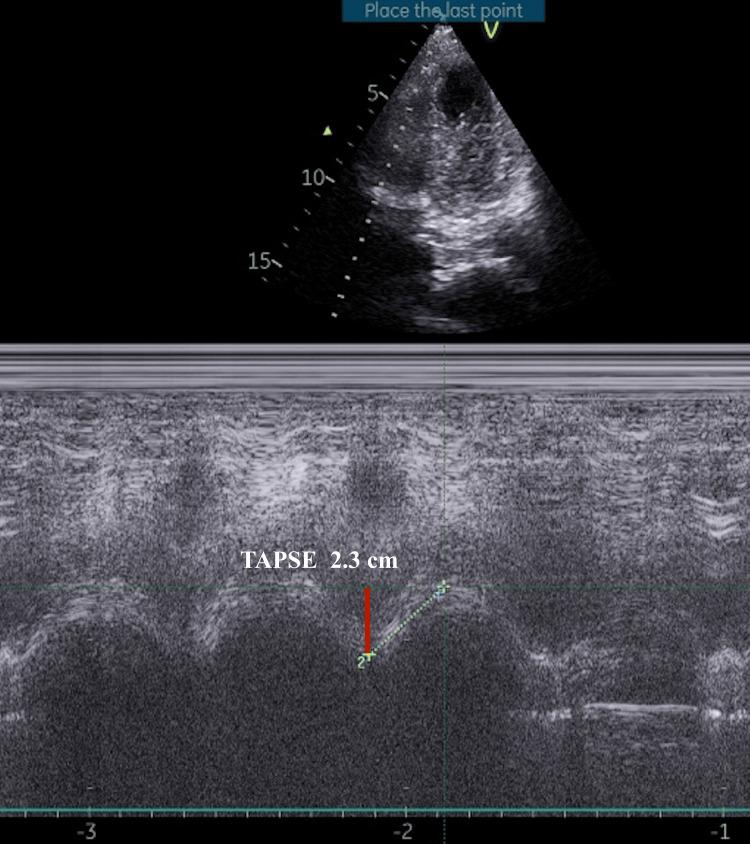 https://cdn.ncbi.nlm.nih.gov/pmc/blobs/988d/12141603/1d25005626ea/cureus-0017-00000083561-i02.jpg
