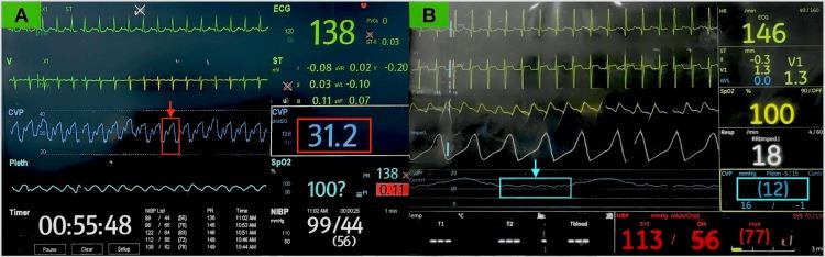 https://cdn.ncbi.nlm.nih.gov/pmc/blobs/988d/12141603/fa15c445aca8/cureus-0017-00000083561-i01.jpg