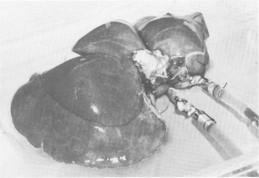 https://cdn.ncbi.nlm.nih.gov/pmc/blobs/9892/1343851/f983425b3c26/annsurg00289-0054-a.jpg