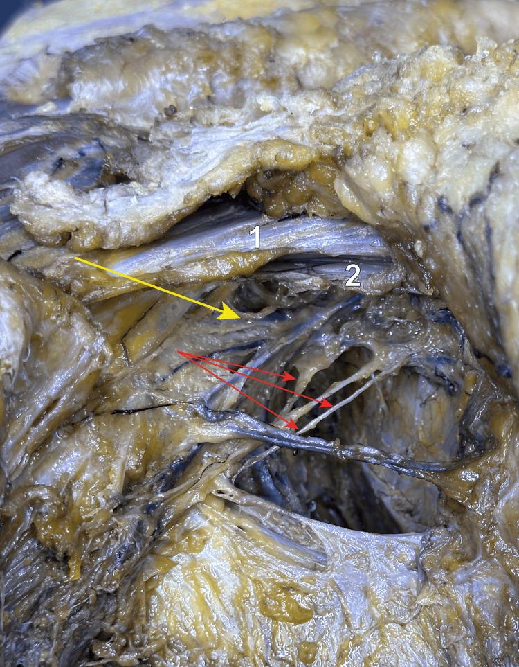 https://cdn.ncbi.nlm.nih.gov/pmc/blobs/98a7/10870804/19f3b4aabc3b/cureus-0016-00000052434-i02.jpg