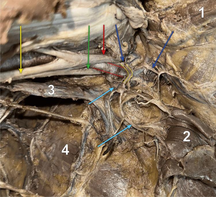 https://cdn.ncbi.nlm.nih.gov/pmc/blobs/98a7/10870804/af6373969d4e/cureus-0016-00000052434-i04.jpg