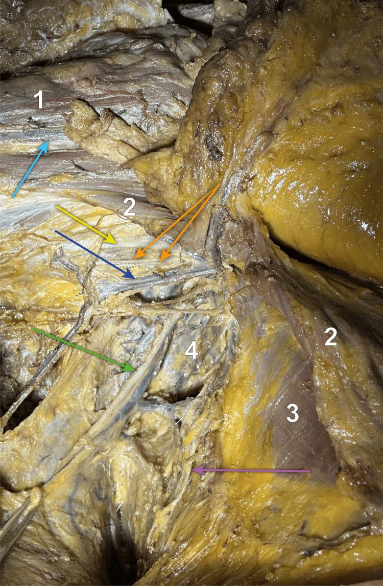 https://cdn.ncbi.nlm.nih.gov/pmc/blobs/98a7/10870804/afca7dd57a11/cureus-0016-00000052434-i03.jpg