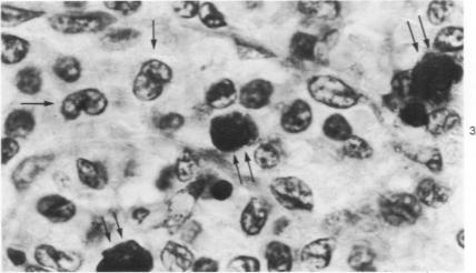 https://cdn.ncbi.nlm.nih.gov/pmc/blobs/98ec/2032246/bea7f6e39c3d/amjpathol00393-0091-c.jpg
