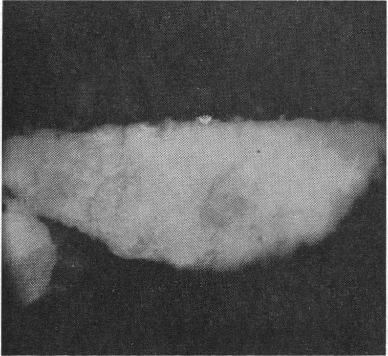 https://cdn.ncbi.nlm.nih.gov/pmc/blobs/98f2/1813393/0ea073763f40/brmedj02615-0039-d.jpg