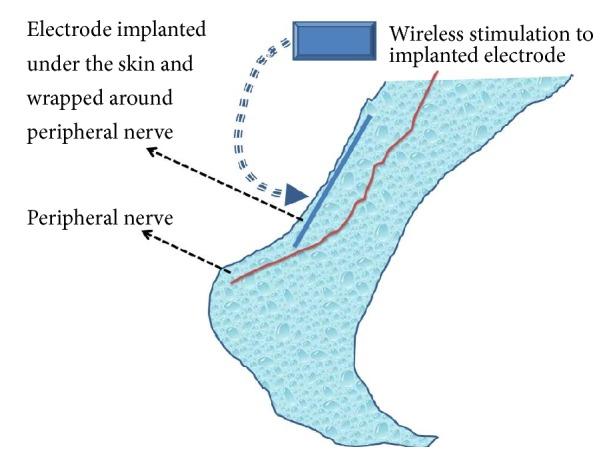 https://cdn.ncbi.nlm.nih.gov/pmc/blobs/9913/6158945/56c835ed02af/PRT2018-9091216.001.jpg