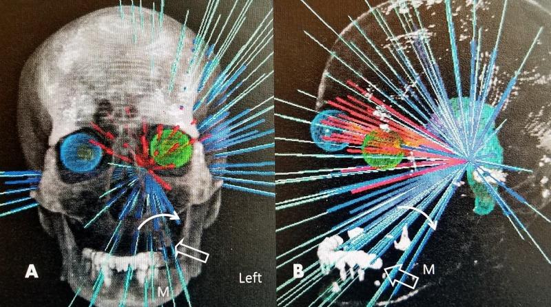 https://cdn.ncbi.nlm.nih.gov/pmc/blobs/9932/5849356/4aa740cb2767/cureus-0010-00000002054-i04.jpg