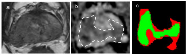 https://cdn.ncbi.nlm.nih.gov/pmc/blobs/9996/10453750/10a8cd0bea44/curroncol-30-00528-g003.jpg