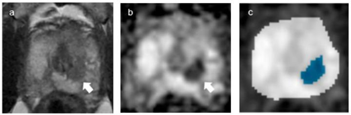 https://cdn.ncbi.nlm.nih.gov/pmc/blobs/9996/10453750/2f9655f2f068/curroncol-30-00528-g006.jpg