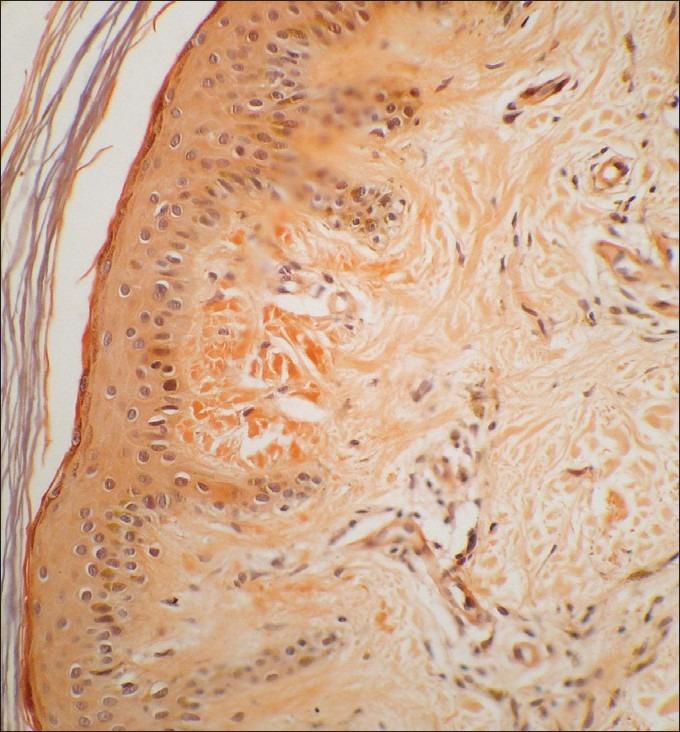 https://cdn.ncbi.nlm.nih.gov/pmc/blobs/99a7/3401840/cdf6f8cc6b9c/IJD-57-269-g004.jpg