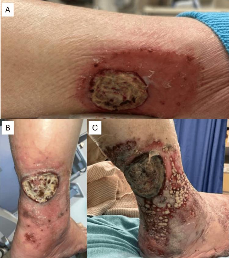 https://cdn.ncbi.nlm.nih.gov/pmc/blobs/9a75/12326212/2d5ef0ff197a/cureus-0017-00000089352-i08.jpg