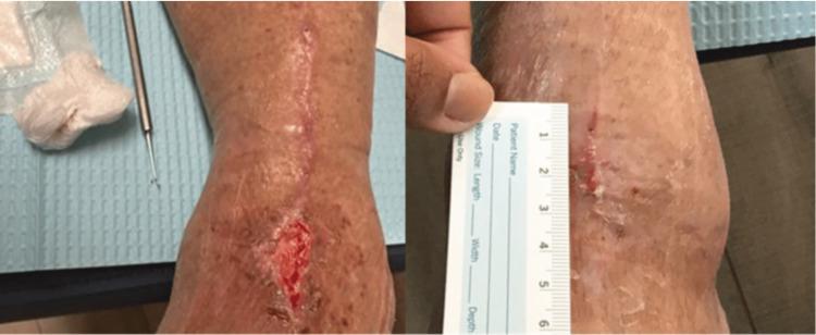 https://cdn.ncbi.nlm.nih.gov/pmc/blobs/9a75/12326212/9be35cf8ac00/cureus-0017-00000089352-i04.jpg