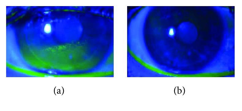 https://cdn.ncbi.nlm.nih.gov/pmc/blobs/9aa9/5742891/6f83e3b1af1c/JOPH2017-2457620.001.jpg