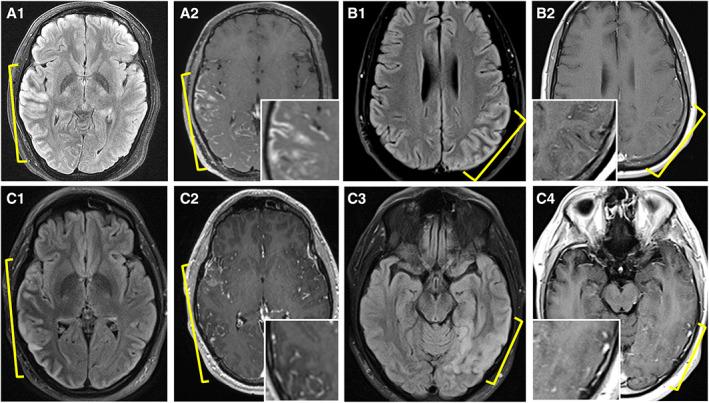 https://cdn.ncbi.nlm.nih.gov/pmc/blobs/9ac7/10107670/8d9968923881/ANA-93-297-g001.jpg
