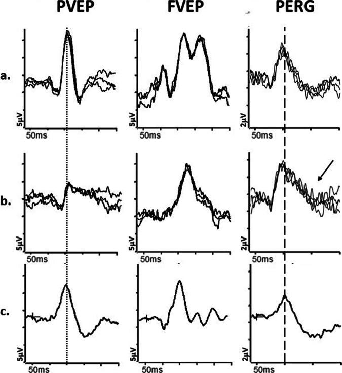 https://cdn.ncbi.nlm.nih.gov/pmc/blobs/9b00/11306601/14e00193ab1d/41433_2024_3154_Fig5_HTML.jpg
