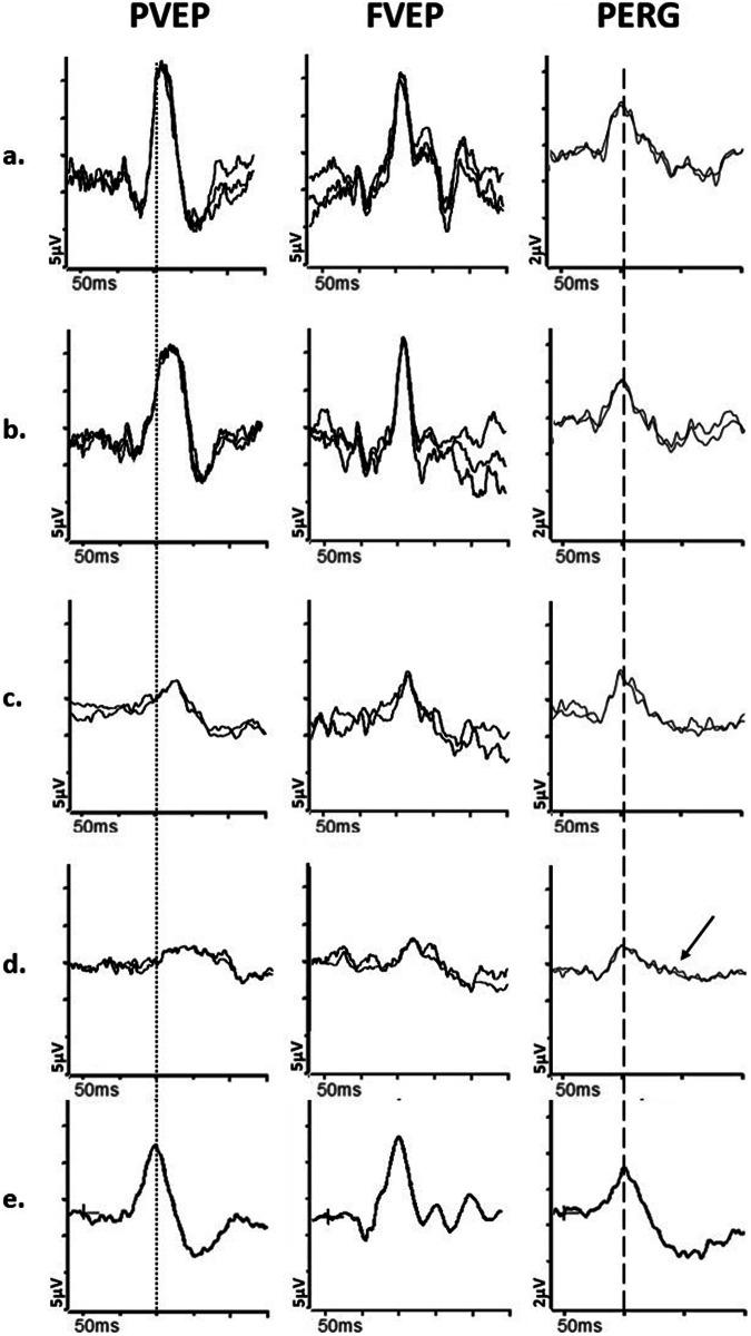 https://cdn.ncbi.nlm.nih.gov/pmc/blobs/9b00/11306601/5e9f430706d8/41433_2024_3154_Fig4_HTML.jpg