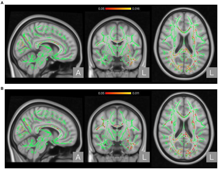 https://cdn.ncbi.nlm.nih.gov/pmc/blobs/9b10/10484711/9567976d528c/fneur-14-1241658-g002.jpg