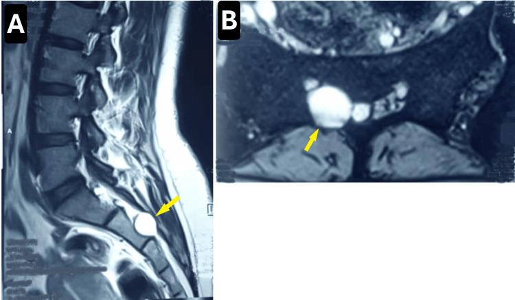 https://cdn.ncbi.nlm.nih.gov/pmc/blobs/9b71/12257255/934d0bc25d57/cureus-0017-00000085982-i01.jpg