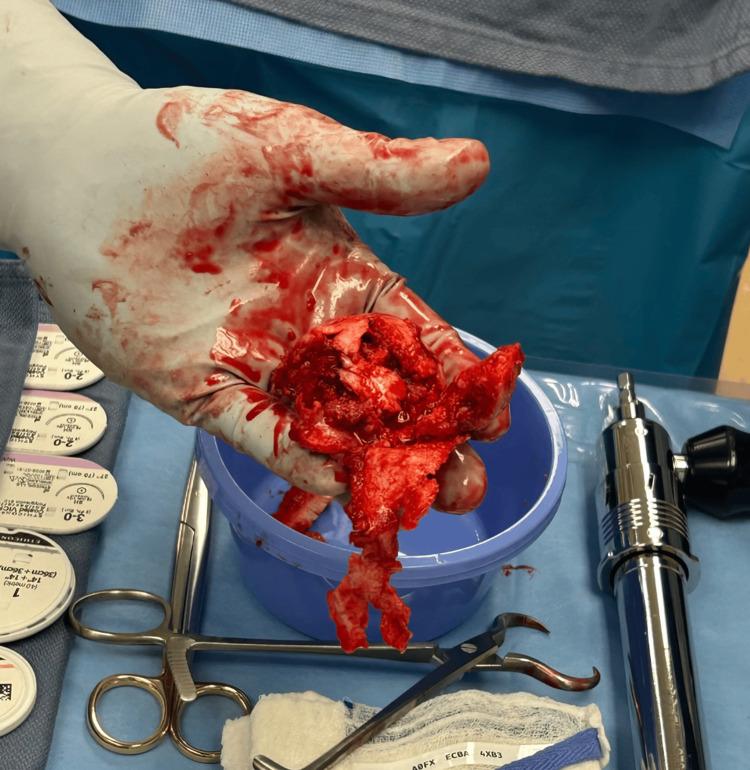 https://cdn.ncbi.nlm.nih.gov/pmc/blobs/9baf/12306698/fa8b2330e6fe/cureus-0017-00000086976-i04.jpg