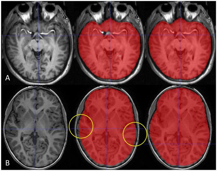 https://cdn.ncbi.nlm.nih.gov/pmc/blobs/9bd8/10503131/5da30c2dd8b6/fneur-14-1221892-g004.jpg