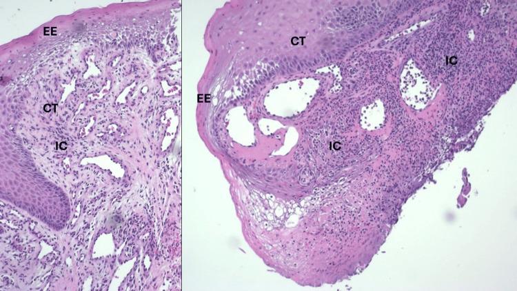 https://cdn.ncbi.nlm.nih.gov/pmc/blobs/9c51/11842033/b5ba1c628f8a/cureus-0017-00000077794-i04.jpg
