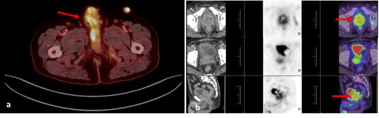 https://cdn.ncbi.nlm.nih.gov/pmc/blobs/9c72/11972621/4a8874a9b228/cureus-0017-00000080222-i02.jpg