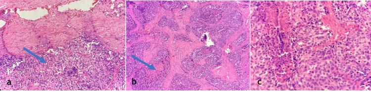 https://cdn.ncbi.nlm.nih.gov/pmc/blobs/9c72/11972621/ac364a700266/cureus-0017-00000080222-i03.jpg