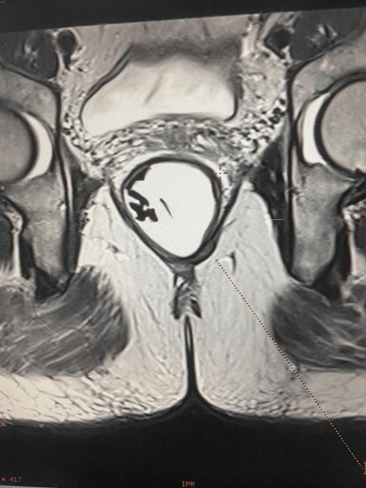 https://cdn.ncbi.nlm.nih.gov/pmc/blobs/9ca2/10244938/5f3908f64cee/cureus-0015-00000038690-i03.jpg