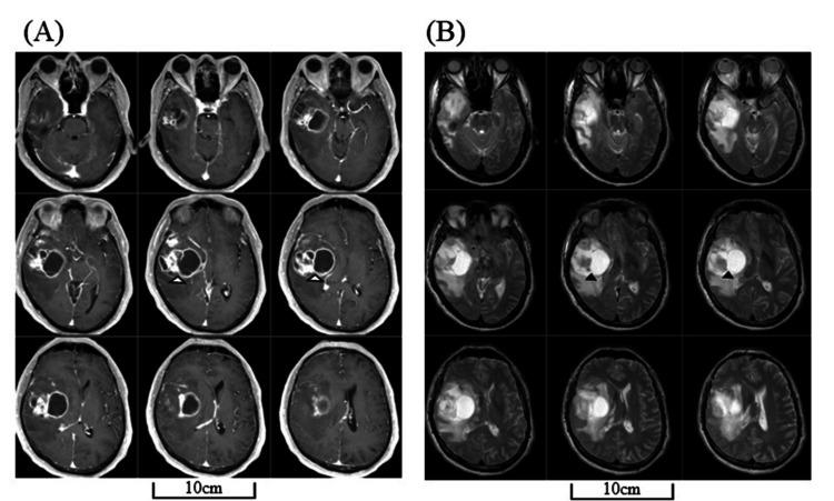 https://cdn.ncbi.nlm.nih.gov/pmc/blobs/9cb6/11761159/82610adad4e6/cureus-0016-00000076385-i01.jpg