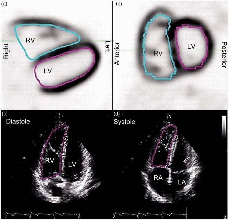 https://cdn.ncbi.nlm.nih.gov/pmc/blobs/9cf5/5467932/f92107c8408a/10.1177_2045893217701917-fig1.jpg