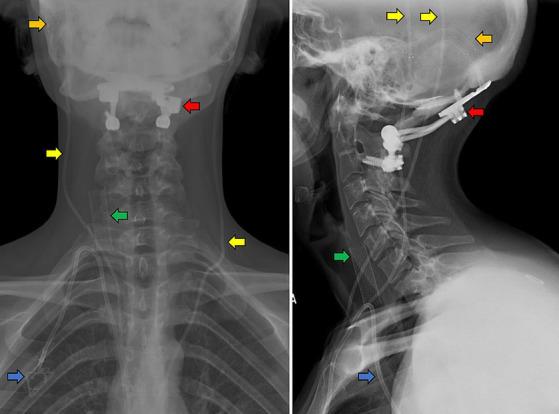 https://cdn.ncbi.nlm.nih.gov/pmc/blobs/9cf7/10806170/29456a3d7335/fneur-14-1305972-g001.jpg