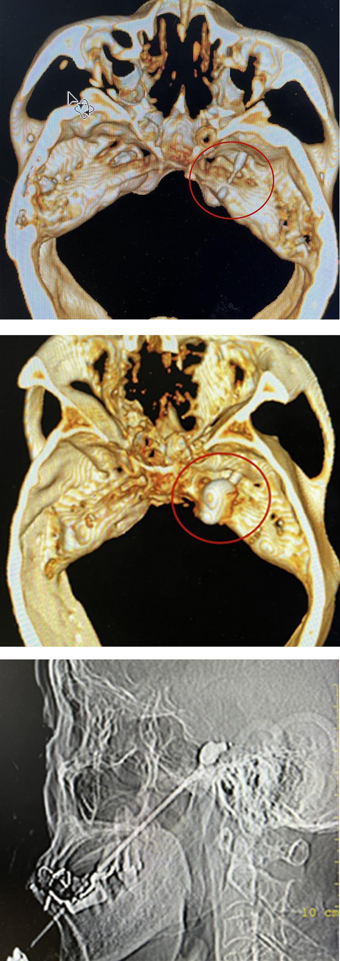 https://cdn.ncbi.nlm.nih.gov/pmc/blobs/9d05/10797886/5c6cebb619f4/fneur-14-1336261-g002.jpg