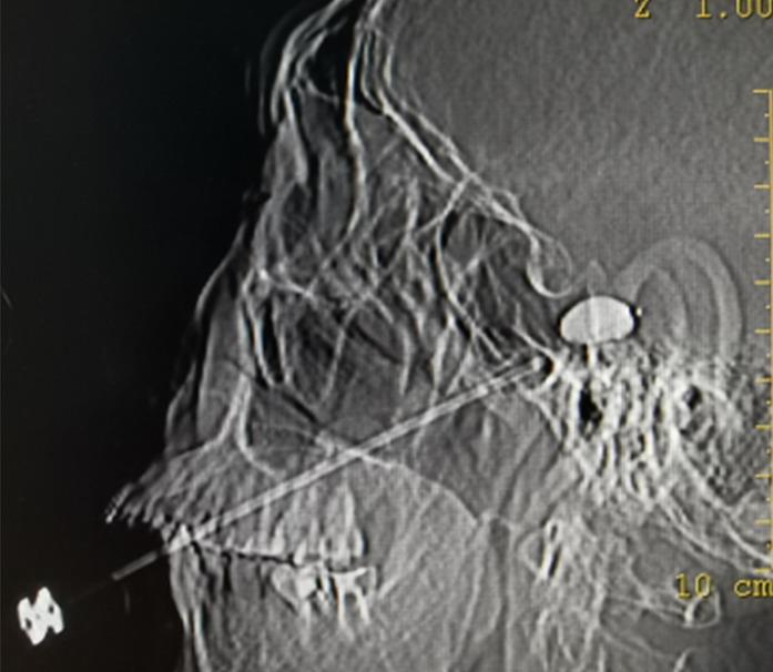 https://cdn.ncbi.nlm.nih.gov/pmc/blobs/9d05/10797886/80e7cc0b7a23/fneur-14-1336261-g004.jpg