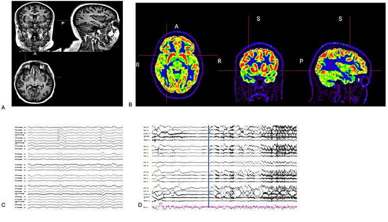 https://cdn.ncbi.nlm.nih.gov/pmc/blobs/9d13/11897517/2db1e4b45e88/fsurg-12-1535408-g001.jpg