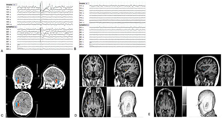https://cdn.ncbi.nlm.nih.gov/pmc/blobs/9d13/11897517/2ff4dfa507c6/fsurg-12-1535408-g004.jpg