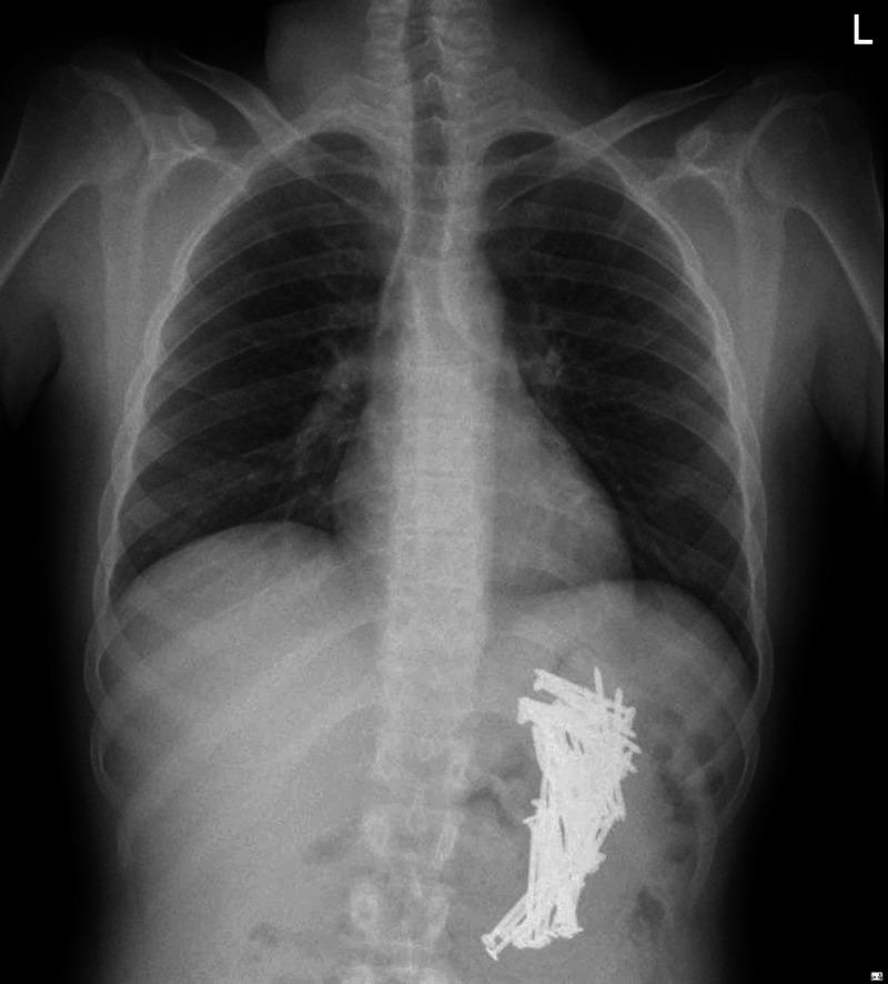 https://cdn.ncbi.nlm.nih.gov/pmc/blobs/9d82/7797438/cf5ba5483a2f/cureus-0013-00000012597-i01.jpg