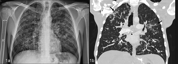 https://cdn.ncbi.nlm.nih.gov/pmc/blobs/9d84/7685013/8ca16c059f5b/omaa095f1.jpg