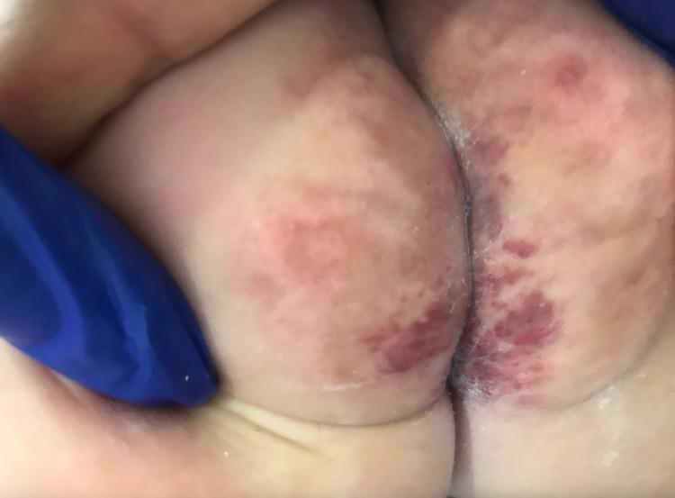 https://cdn.ncbi.nlm.nih.gov/pmc/blobs/9d8c/8864578/436ffdc82fd8/cureus-0014-00000021545-i04.jpg